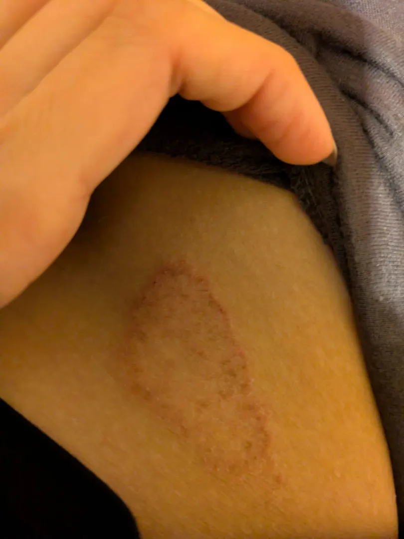Persistent itchy patch on partner's hip (F) Getting worse over 8 weeks. Doesn't feel like her usual eczema. Any ideas?