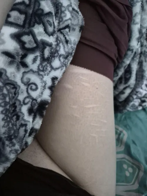Pully my pants down to show you my scars