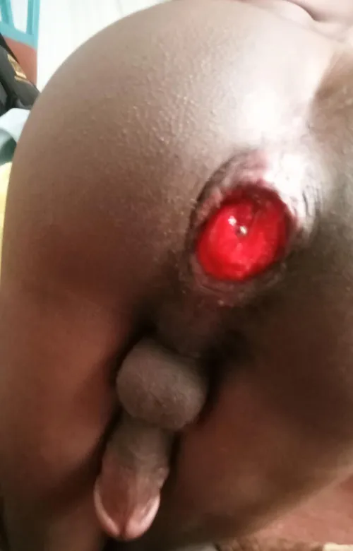 Pushing for a fully bloomed prolapse.