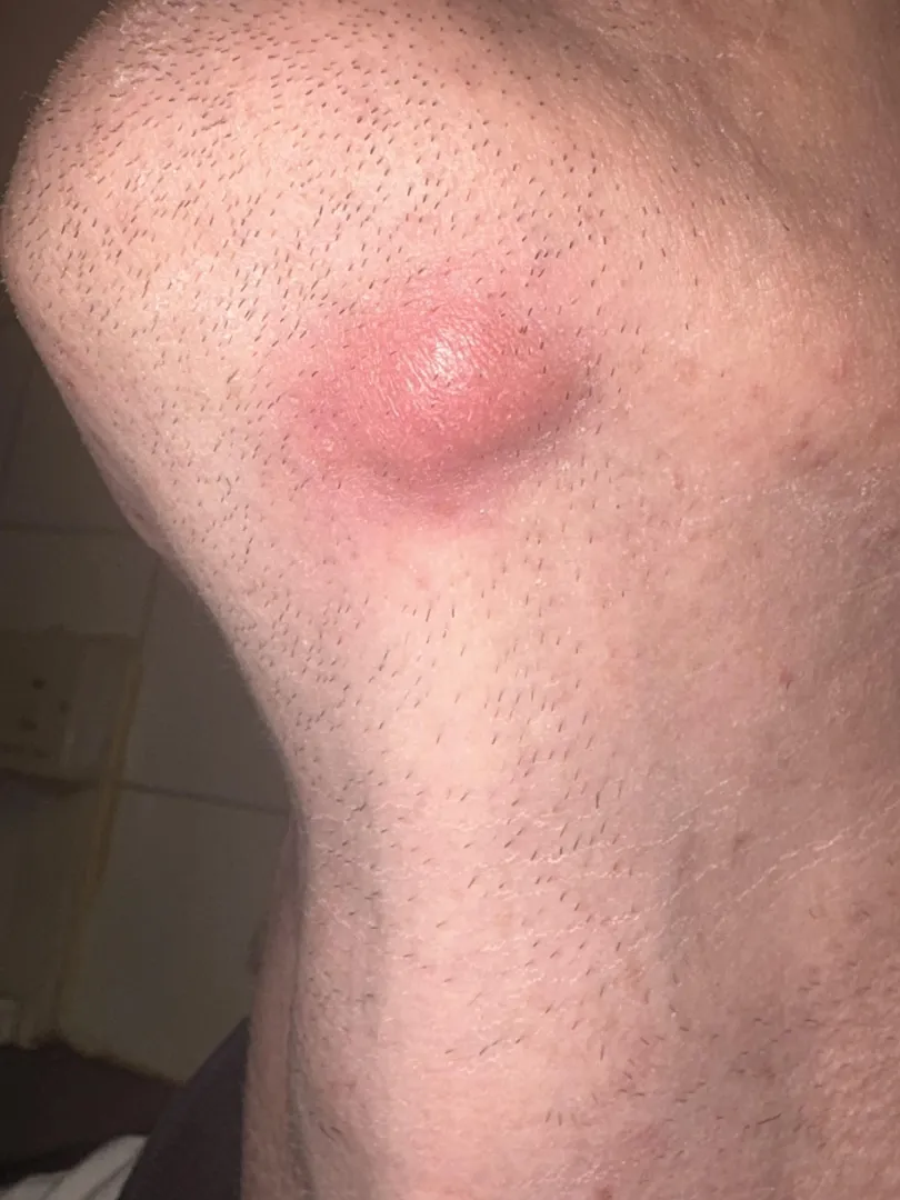 Red lump under my chin around 2-3 cm in size. No head or mark indicating a bite or a boil/spot.