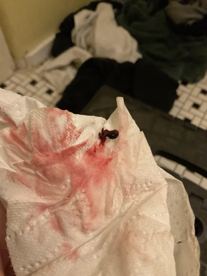 So, I have no idea if I was pregnant prior, but I was sexually active and on the pill. I’ve had odd symptoms for weeks that only went away when I started bleeding, then I pasted this. Is it a miscarriage or tissue? It’s never looked this way before. 