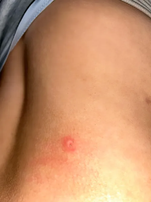 Sore appeared on my back overnight, when I woke up it had a blister over it. On my lower right hand side of my back