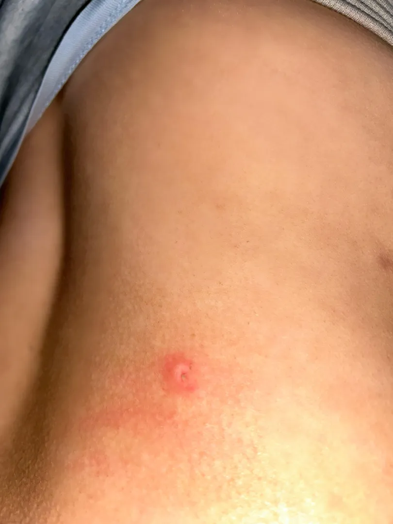 Sore appeared on my back overnight, when I woke up it had a blister over it. On my lower right hand side of my back