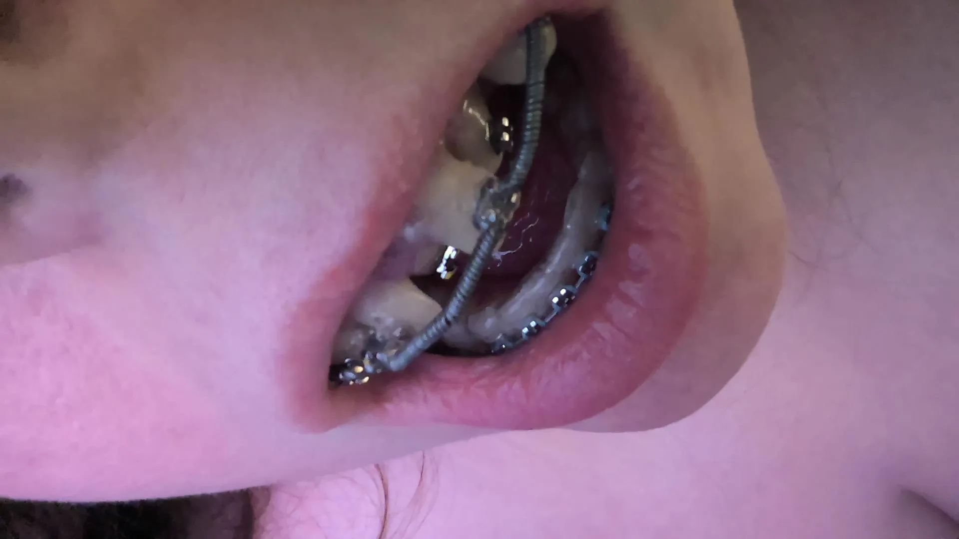 super crooked braces