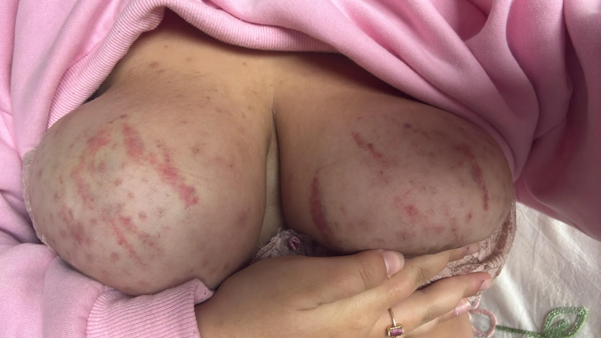 the day after snapping rubber bands on my tits