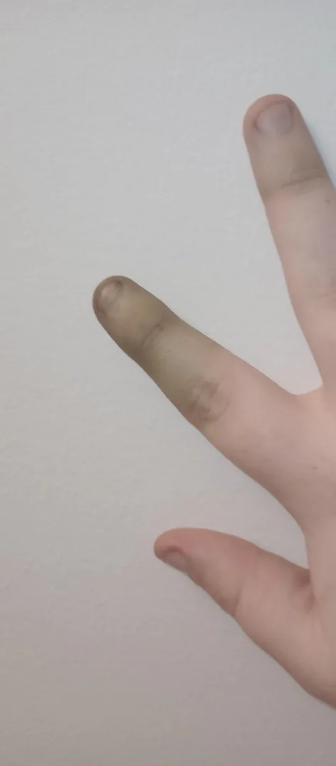 The nail is starting to grow back but my finger is green and bruised. 75lbs dumbbell. I've smashed my fingers more times than I can count.