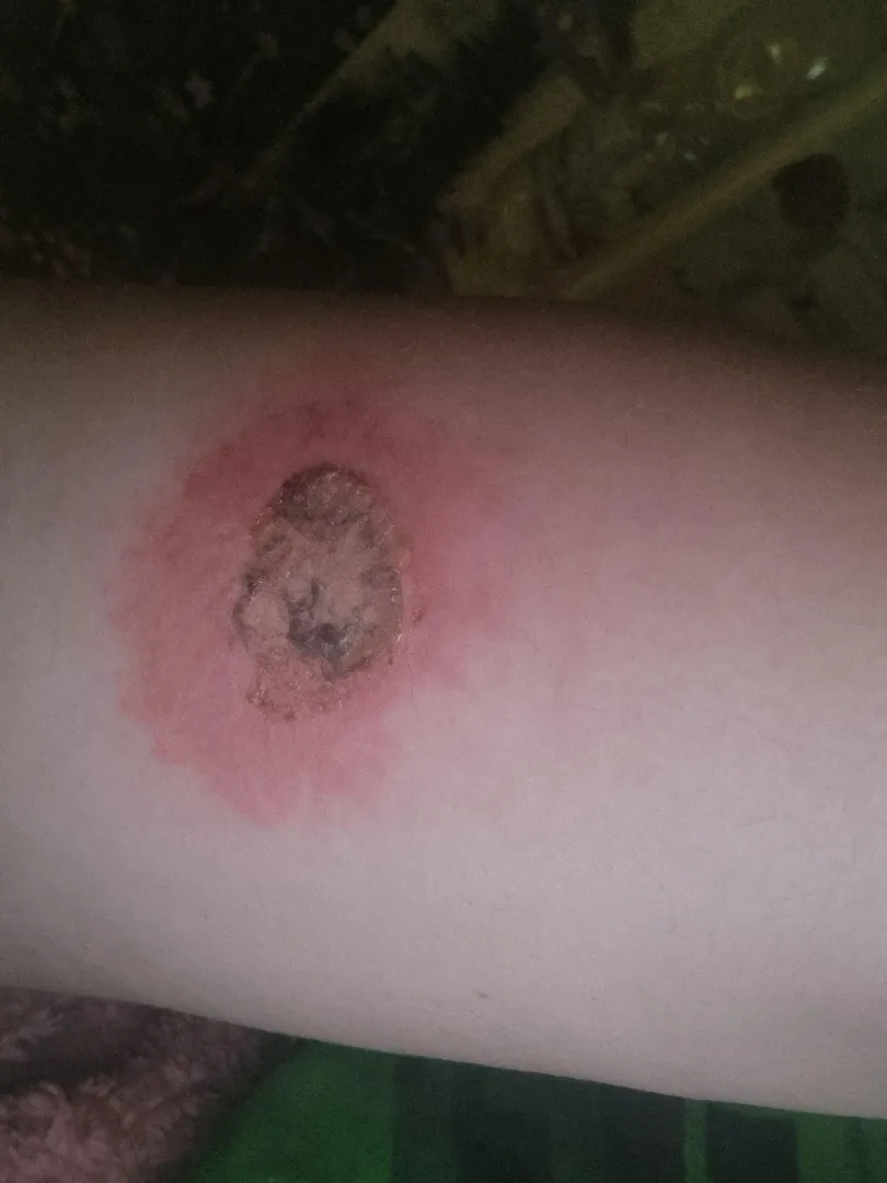 This just will not heal