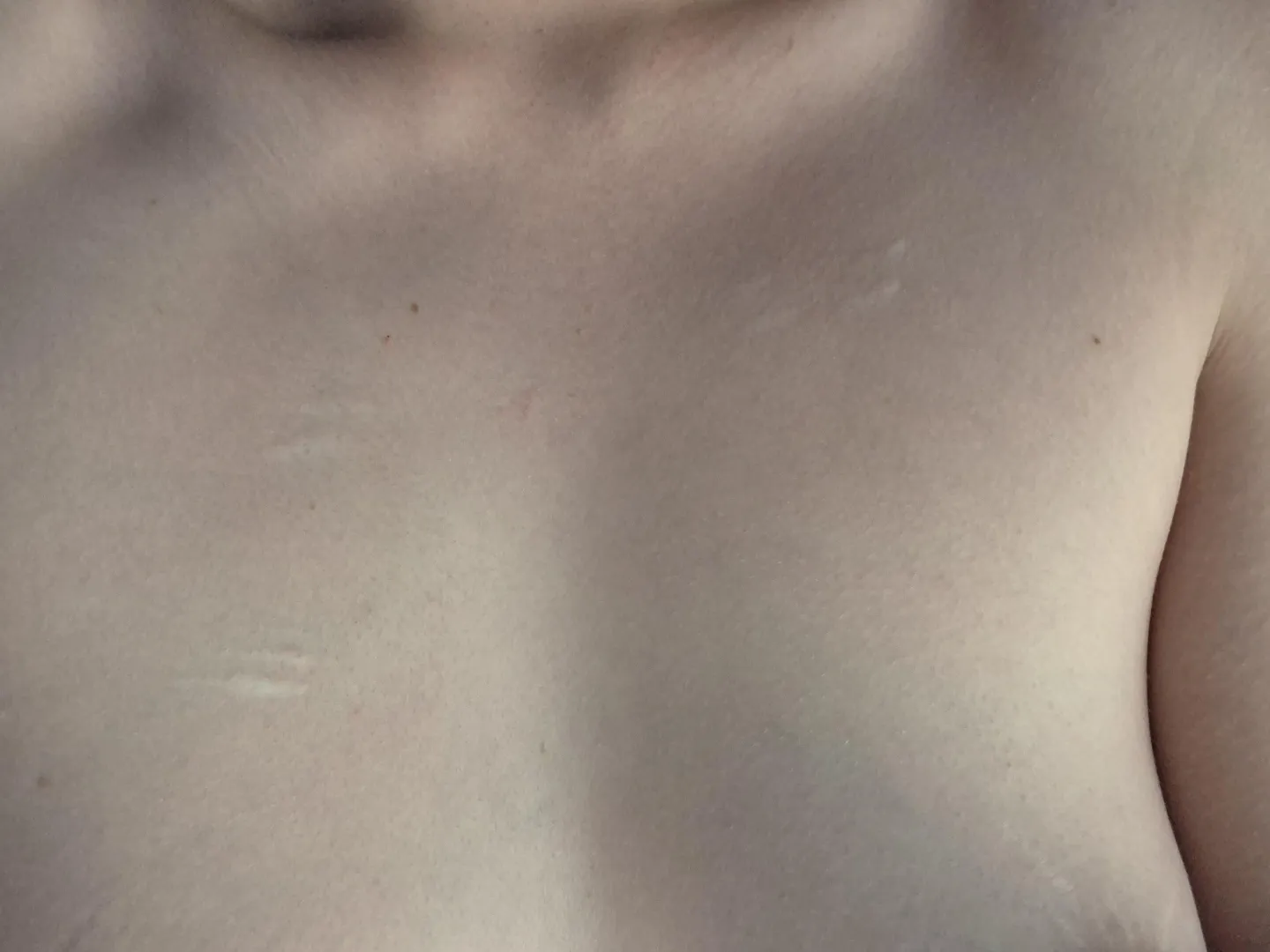 Tiny little chest scars