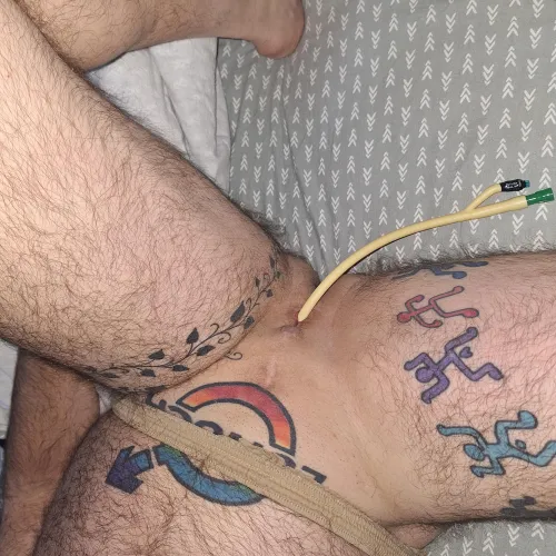 Waking up with a 28 fr catheter