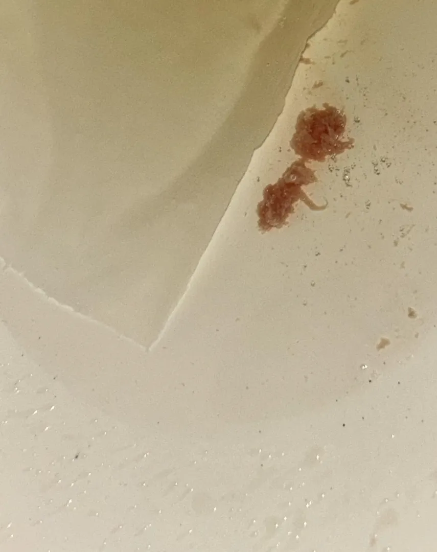 Weird pink chunky discharge after sex? I’m stressed, please help!!