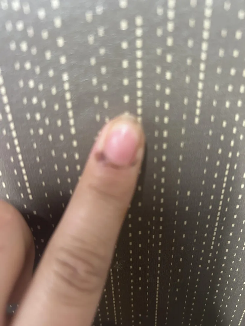 What is this on my nail? It doesn’t hurt, it is peeling and is purple.