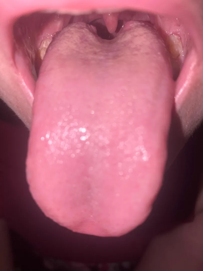 White spots on tongue?they appeared around a month ago, the air has been really dry.