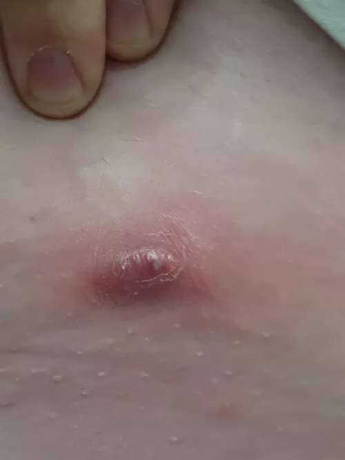 I really hate my body sometimes... angry boil right on my waist line. Tylenol for swelling, but if it doesn't go down by tomorrow, I'm seeing a doctor.