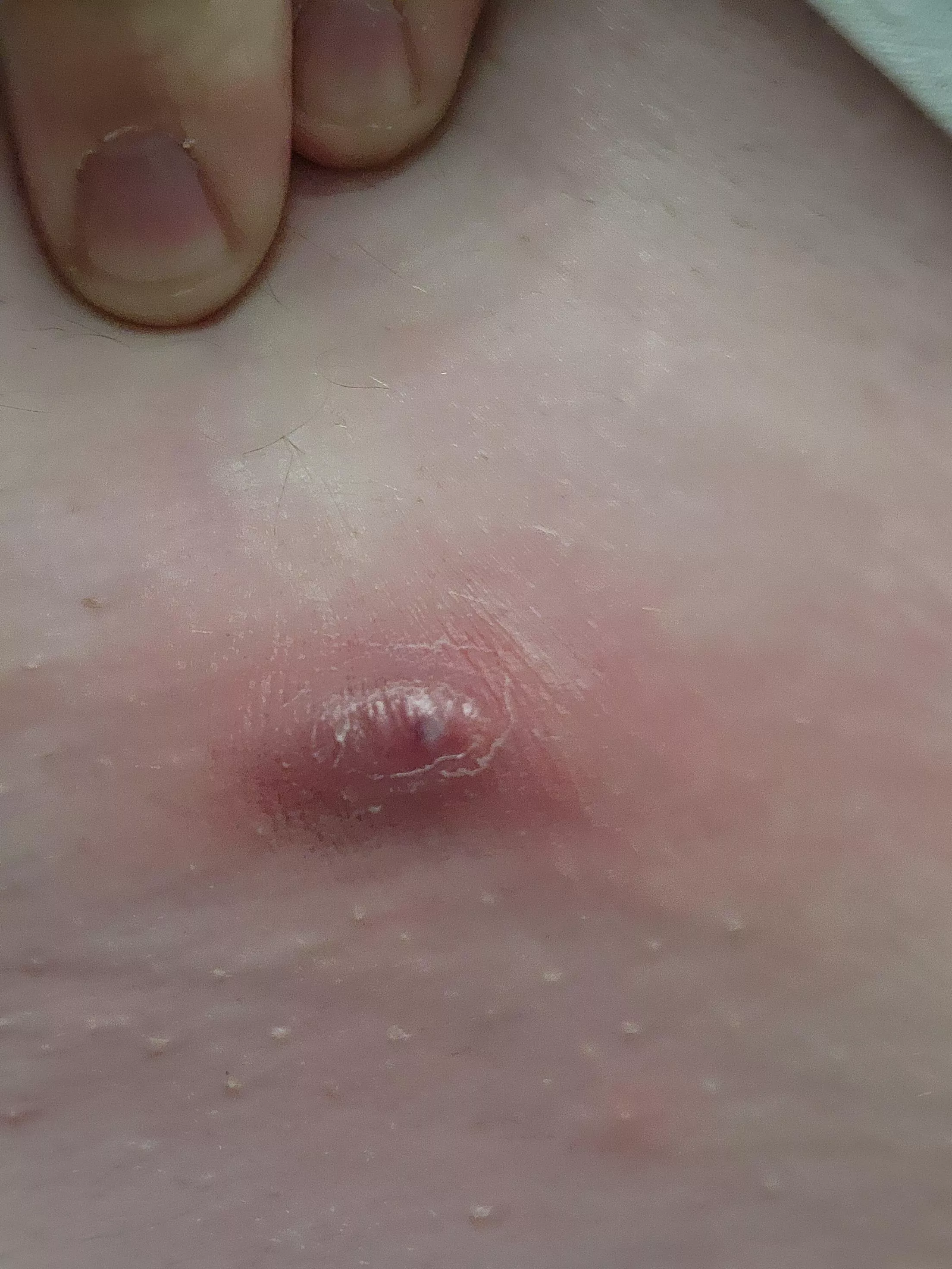 I really hate my body sometimes... angry boil right on my waist line. Tylenol for swelling, but if it doesn't go down by tomorrow, I'm seeing a doctor.