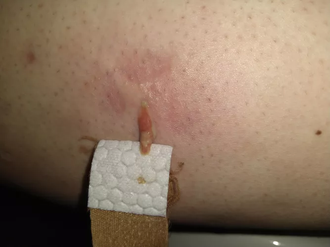 I'm getting sick and fuckin tired of these ingrown hairs. I'll be having my first laser hair removal appointment for my legs end of this month. Seemed to have helped with my face.