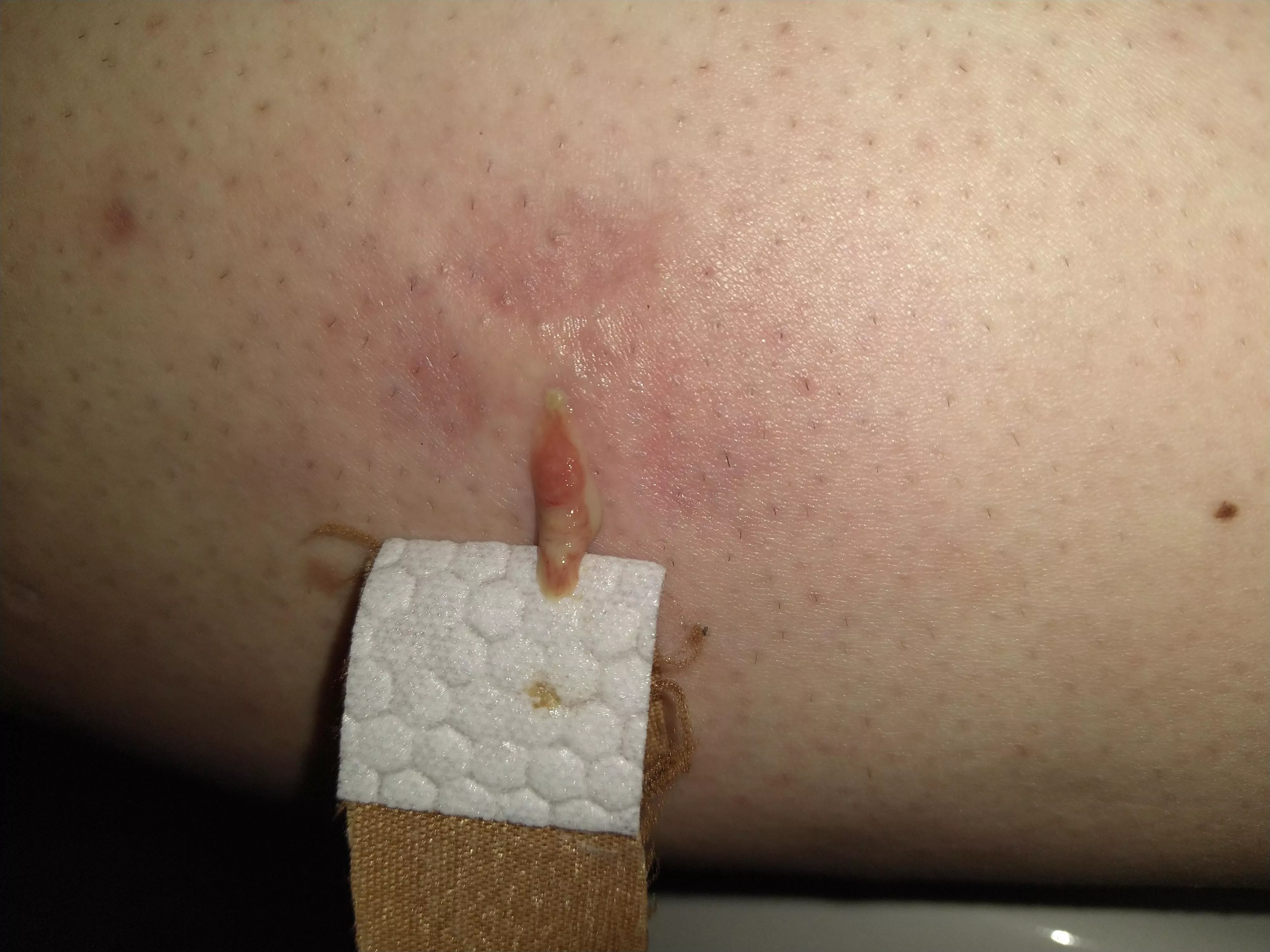 I'm getting sick and fuckin tired of these ingrown hairs. I'll be having my first laser hair removal appointment for my legs end of this month. Seemed to have helped with my face.