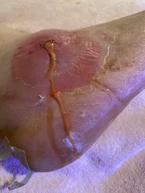 Post Surgery… figured y’all would appreciate it. Enjoy!