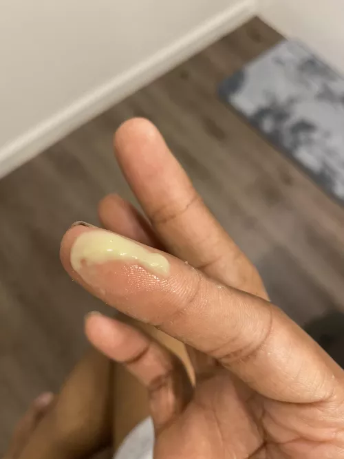 So this is what I go through with Dissecting cellulitis