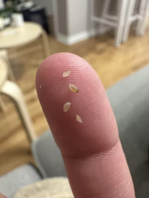 chest blackheads…. iphone 14 zoom goes crazy