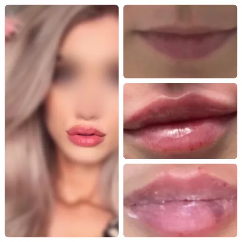 Third round of lip fillers booked! Hoping for the perfect bimbo pout!