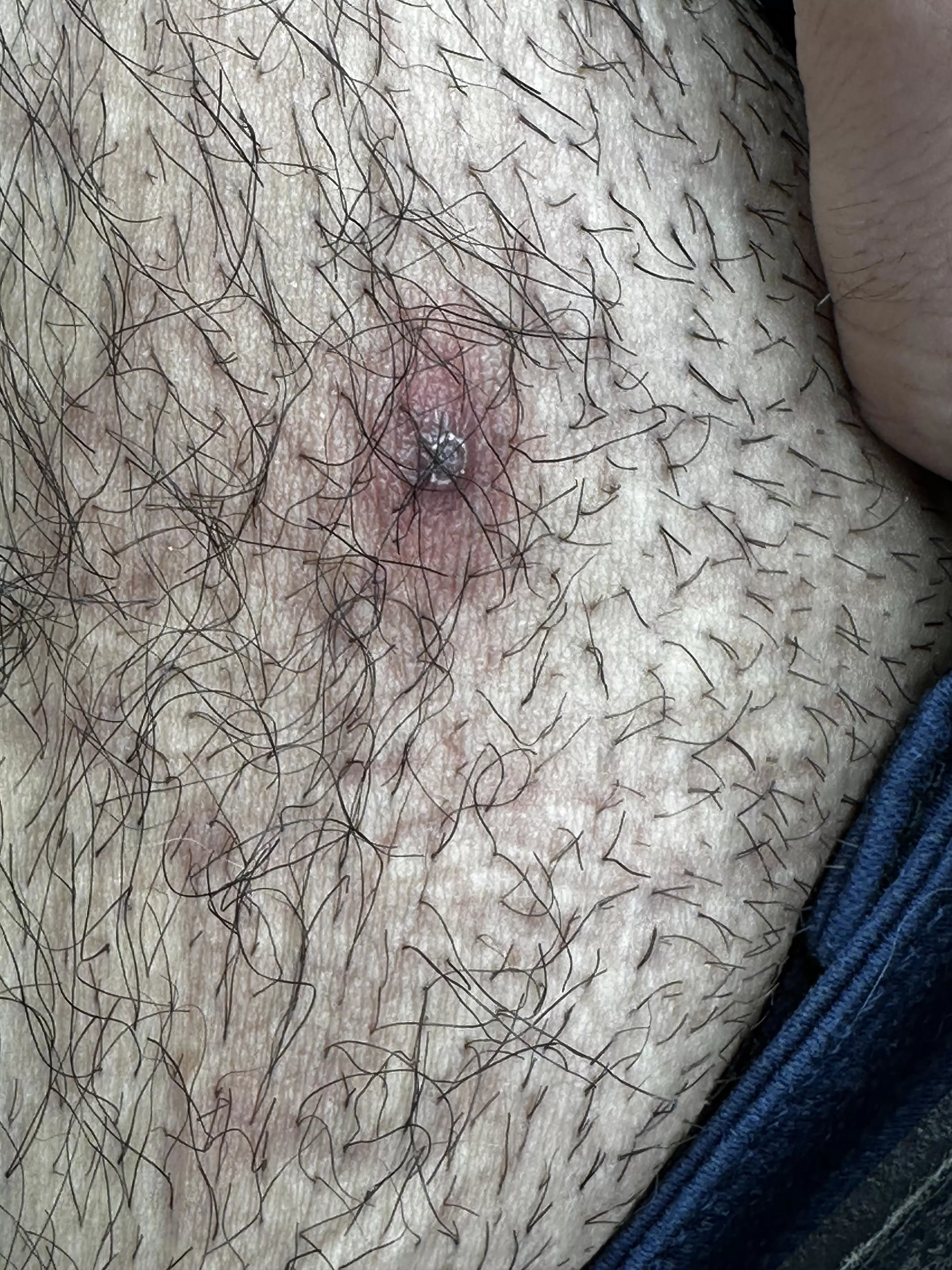 What’s this and should I go for popping it? It hurts touching it too (it’s under my belly button)