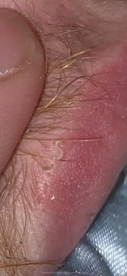 first time poster. 2 distant cousins i squeezed out of my boyfriends lip.