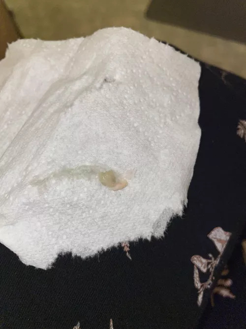 I finally got the core out of my abscess!!!