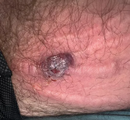 Swollen cyst/pimple on stretch mark, hurts like hell. Any idea what it might be?