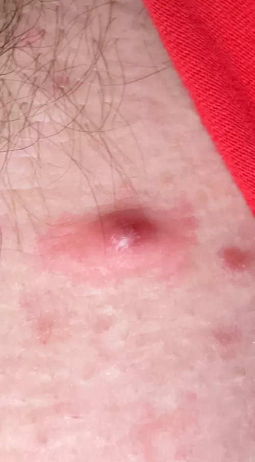 Is this an ingrown?? If so, i’ll have my gf take a video when she removes it!