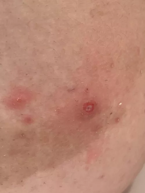 Popped a pimple, left this narly hole after a few weeks of picking at it the scab.