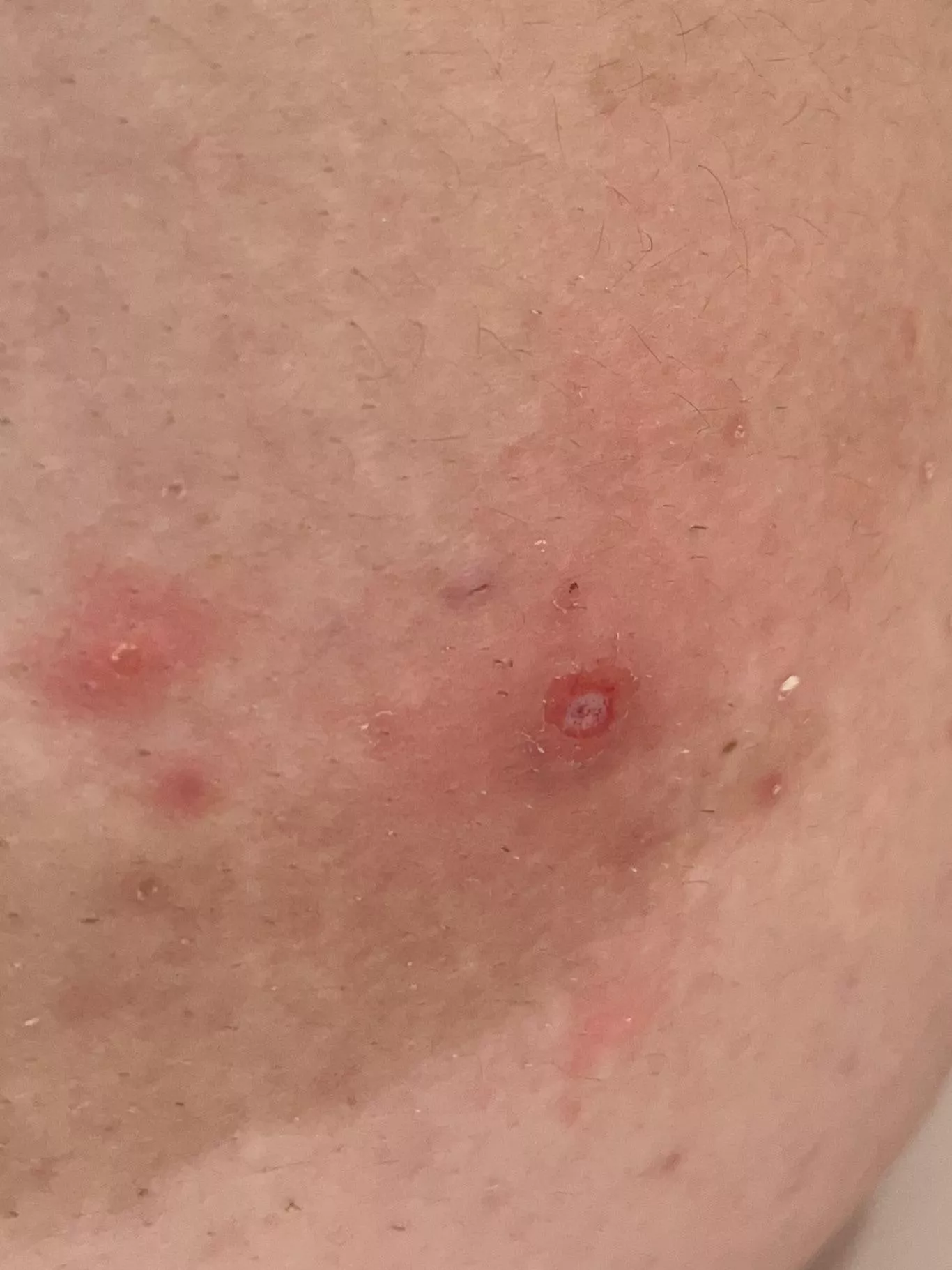 Popped a pimple, left this narly hole after a few weeks of picking at it the scab.