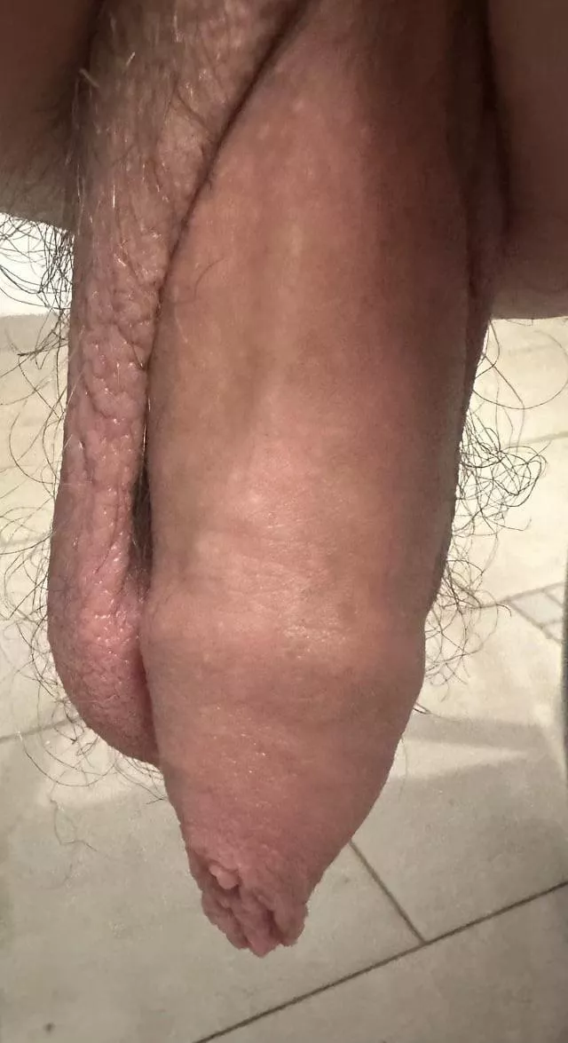 I (m24) hate my too long foreskin! Any experiences here with a surgery to get rid of it? DMs or tips welcome! Thx!