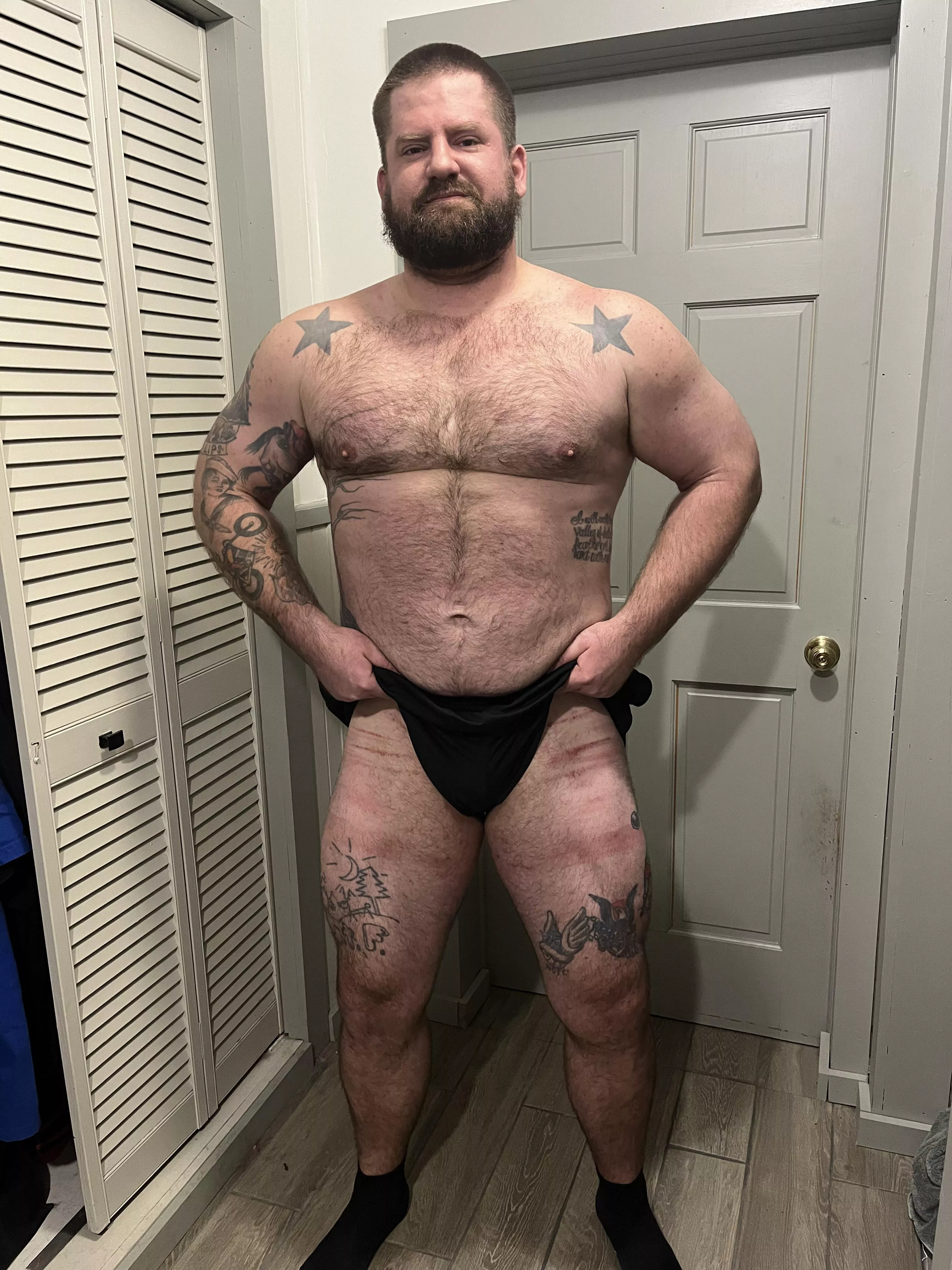 Bruises looking like tiger stripes