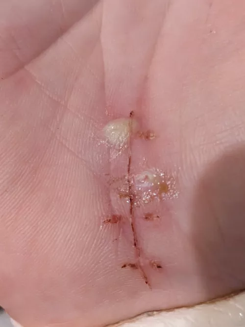 Forbidden Pop - Stitch Abscess. OC