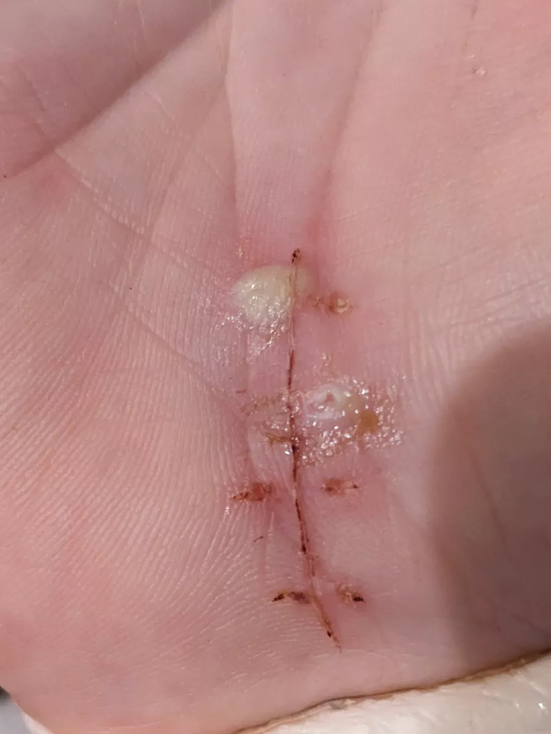 Forbidden Pop - Stitch Abscess. OC