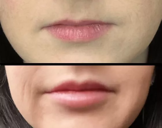 Wife got her first lip upgrades. How do they look?