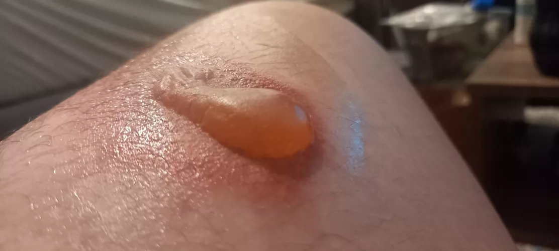 Forgot to do first aid on a burn. Whatever I do, I MUST NOT POP THE BLISTER