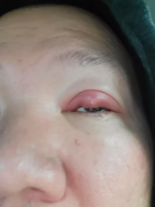 wish I could pop it. the pressure is painful! headed to doctor now