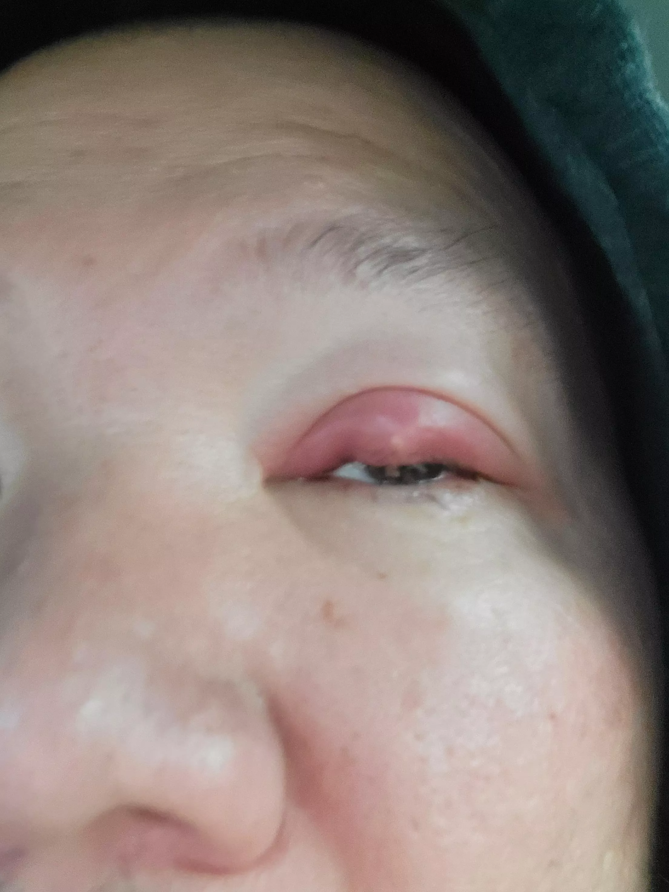 wish I could pop it. the pressure is painful! headed to doctor now