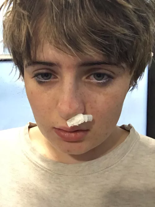My nose is bleeding :(( f18