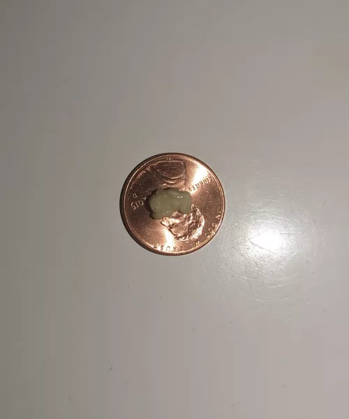 four score and 7 minutes ago I coughed out this tonsil stone