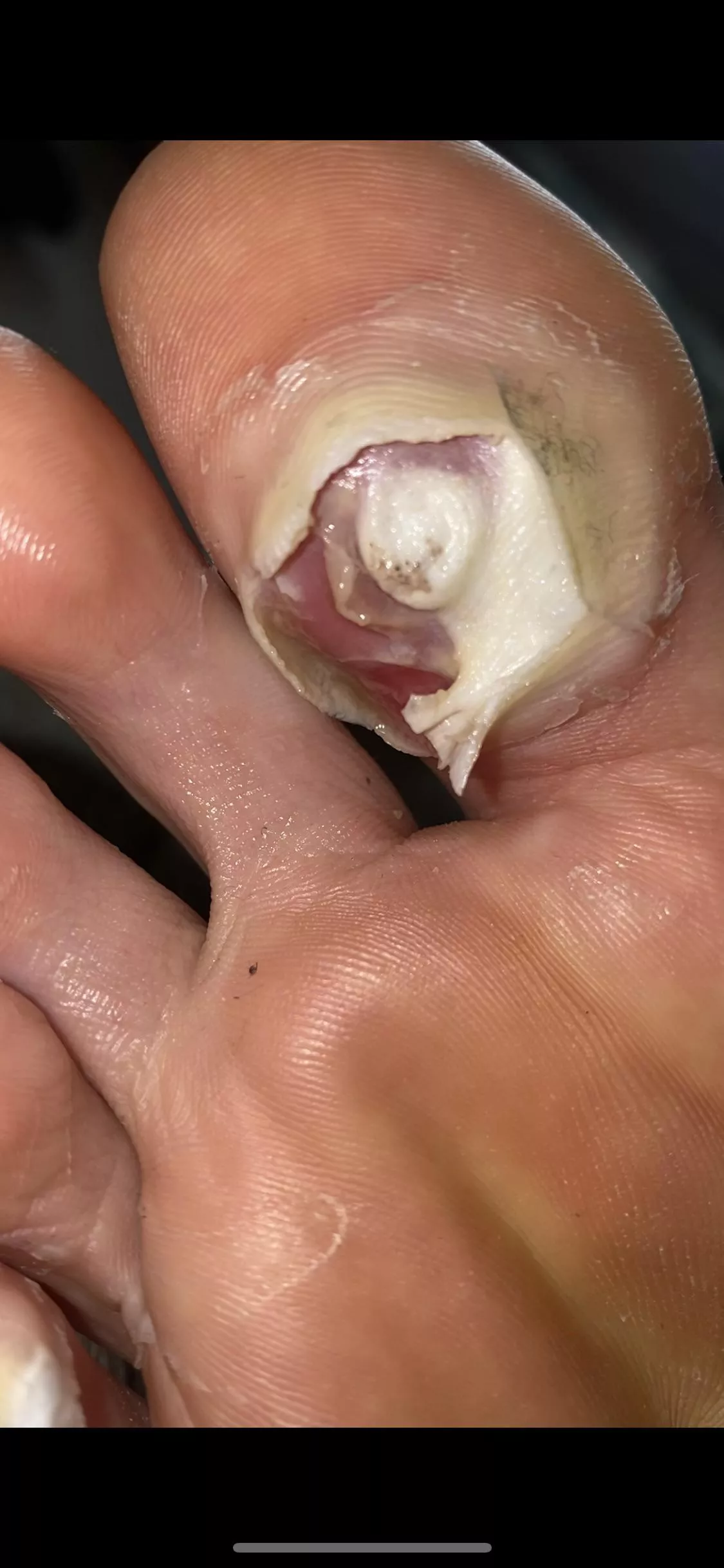 Plantar wart blister popper exposing the inner goodness of the raw wart - any ideas on how to proceed?