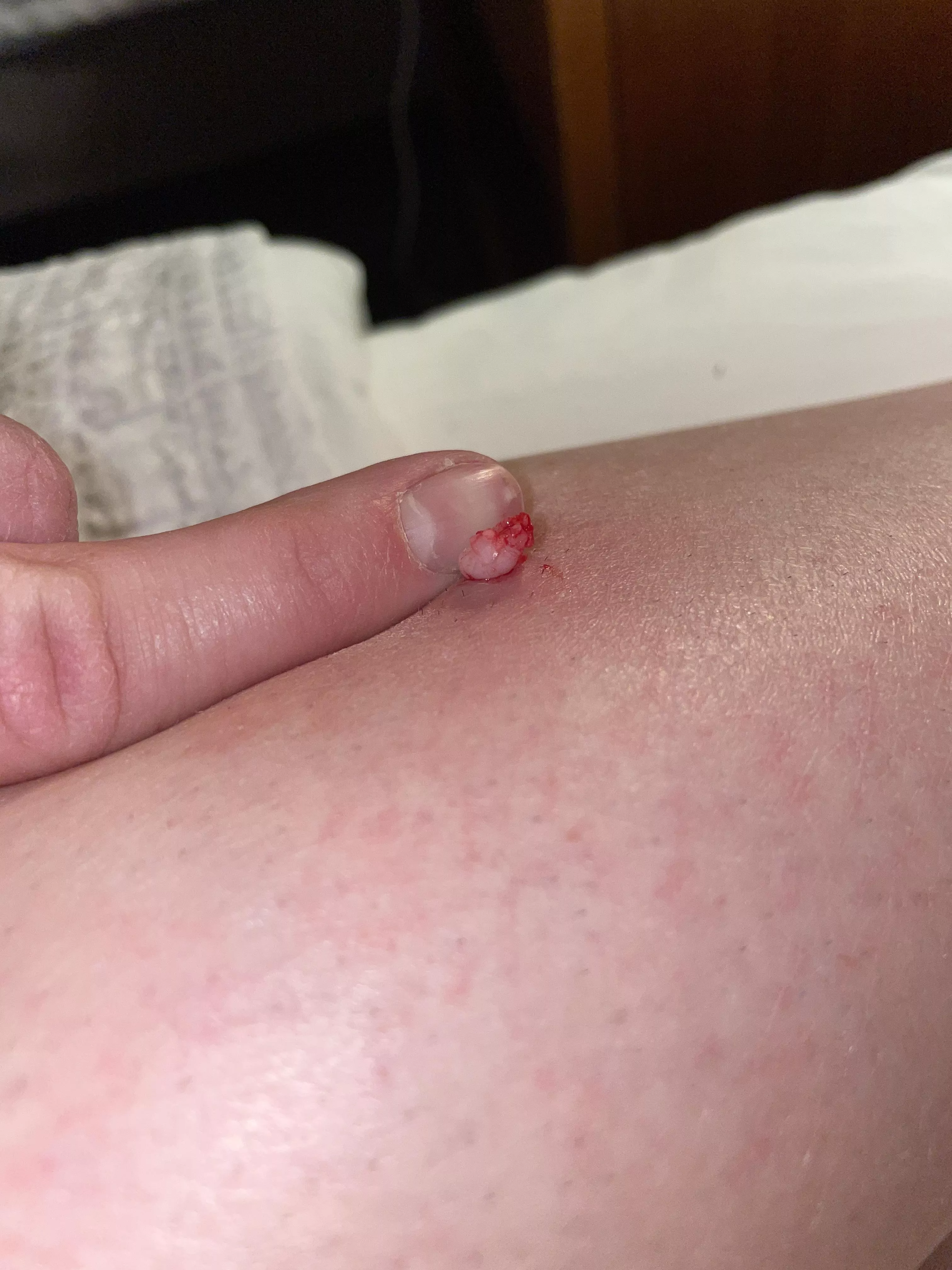 First half of the cyst my girlfriend had in her leg