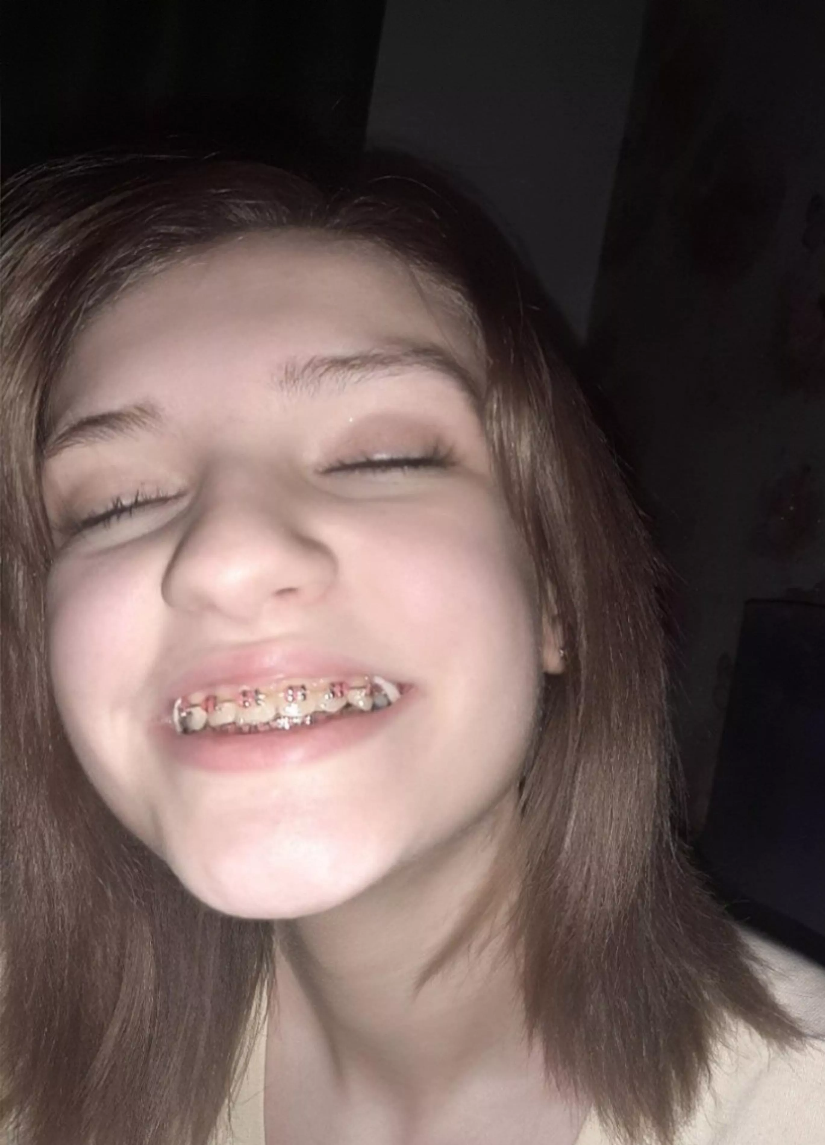 a closeup pic of my braces, perfect for your load to be released on ~♡
