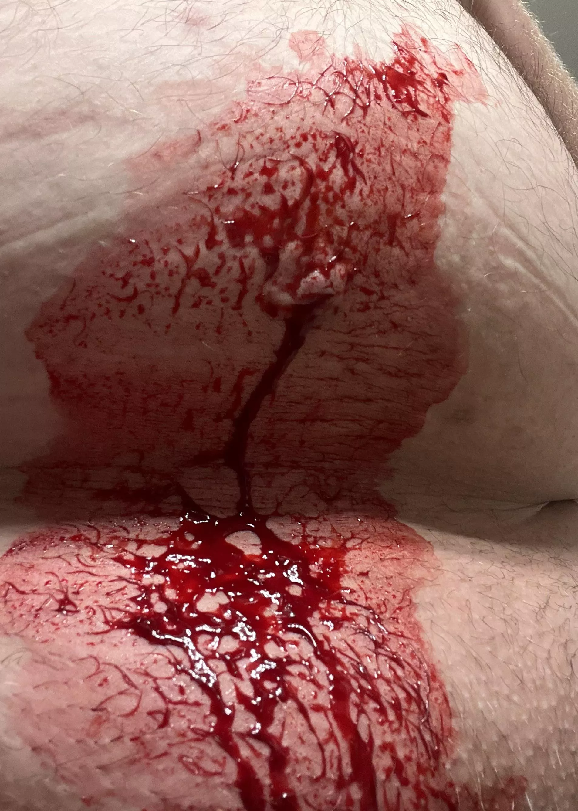 Aftermath of a stomach pop