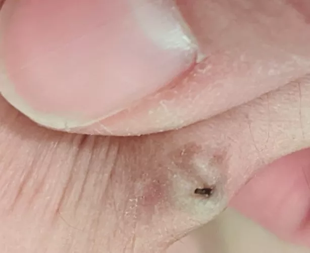 I was inserting old bellybutton piercing. As I was pushing it up from the bottom, this was coming out the top