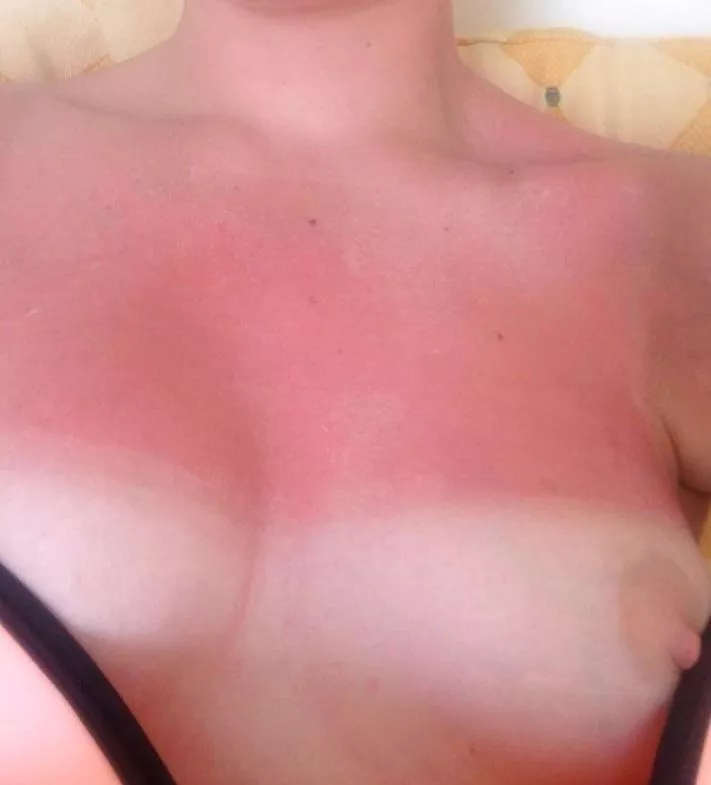the day after stupidly getting burnt, looks like I'm staying indoors today F27 5'10 135llb