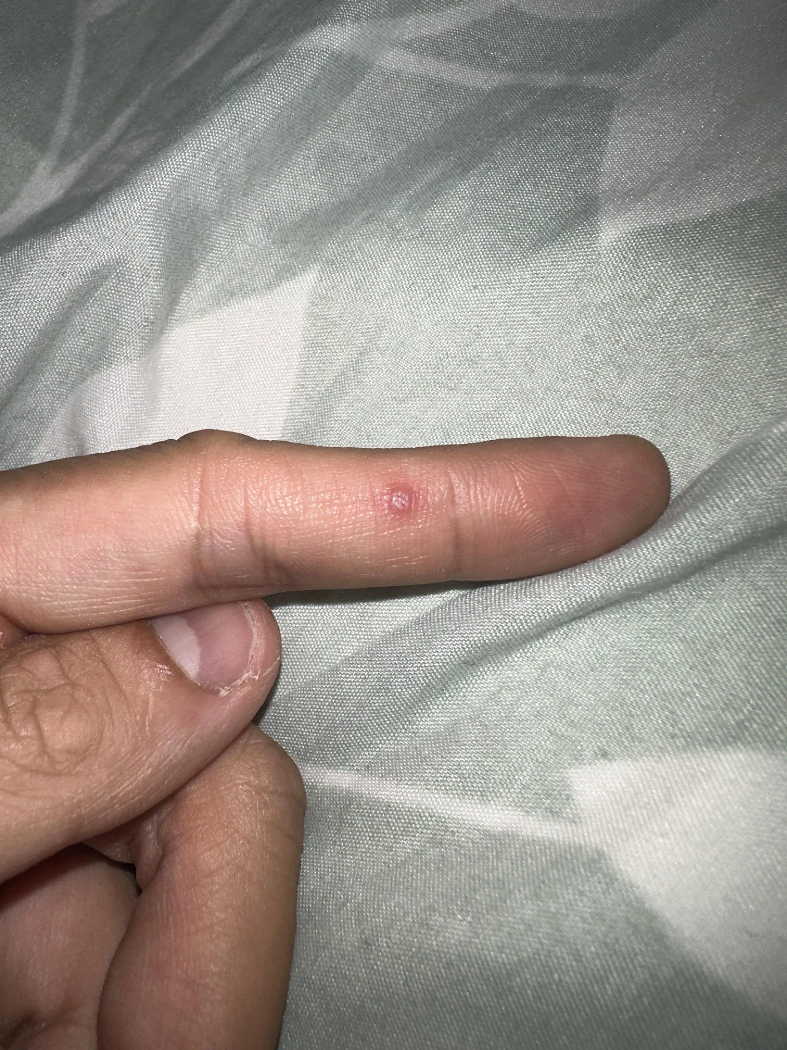 Please help me identify this tiny lesion on my index finger. Every time I put pressure on it there is a little discomfort.
