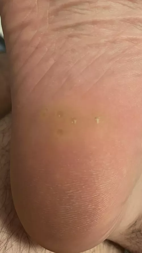 Bumps in my heel. What are they? Won’t pop.