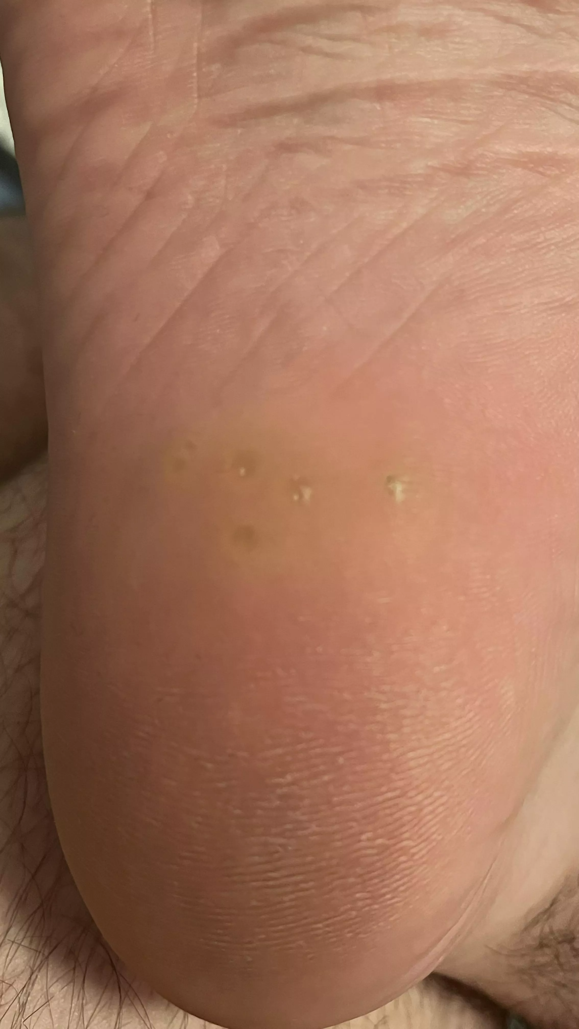 Bumps in my heel. What are they? Won’t pop.